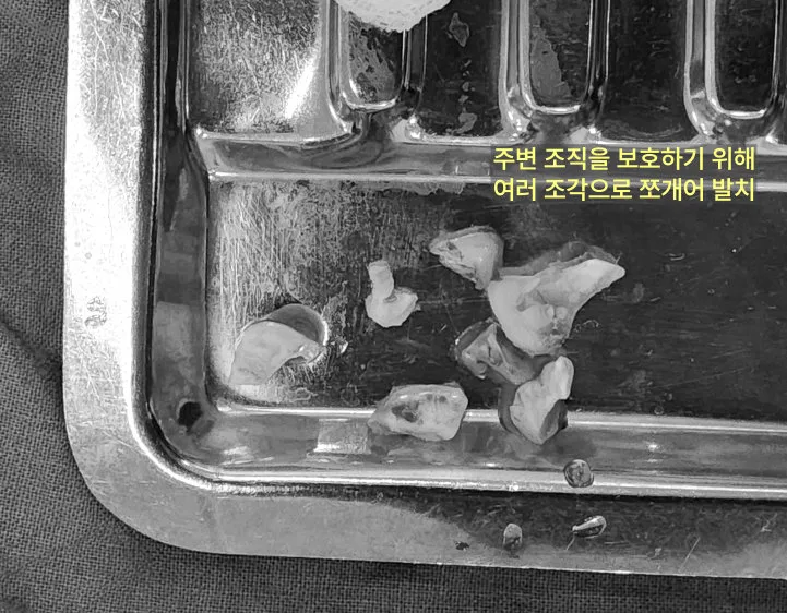여러 조각으로 쪼개어 발치된 사랑니와 낭종 조직 사진