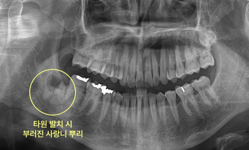 연수구치과 사랑니 잔존 치근, 부러진 뿌리의 판단 기준 5 하악 우측 사랑니 부위에 부러진 뿌리 조각이 남아있는 파노라마 방사선 사진