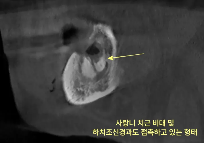 연수구치과 사랑니 잔존 치근, 부러진 뿌리의 판단 기준 6 사랑니 치근 비대 및 하치조신경과 접촉하고 있는 형태를 보여주는 치과 CT 사진