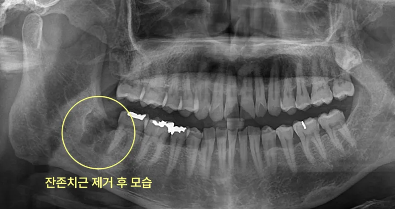 연수구치과 사랑니 잔존 치근, 부러진 뿌리의 판단 기준 9 하악 우측 사랑니 부위의 잔존 치근 제거 후 파노라마 방사선 사진