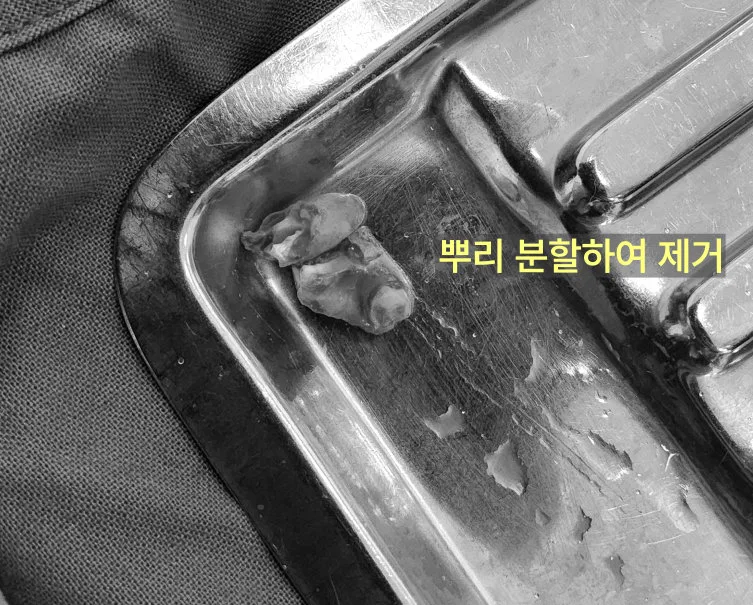 연수구치과 사랑니 잔존 치근, 부러진 뿌리의 판단 기준 10 의료용 쟁반 위에 놓인 분할된 사랑니 뿌리 조각들