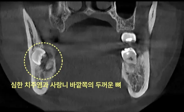 인천구월동치과 발치 후 다시 아픈 이유 4 하악 좌측에 매복된 사랑니와 주변 뼈의 모습을 보여주는 치과 CT 사진