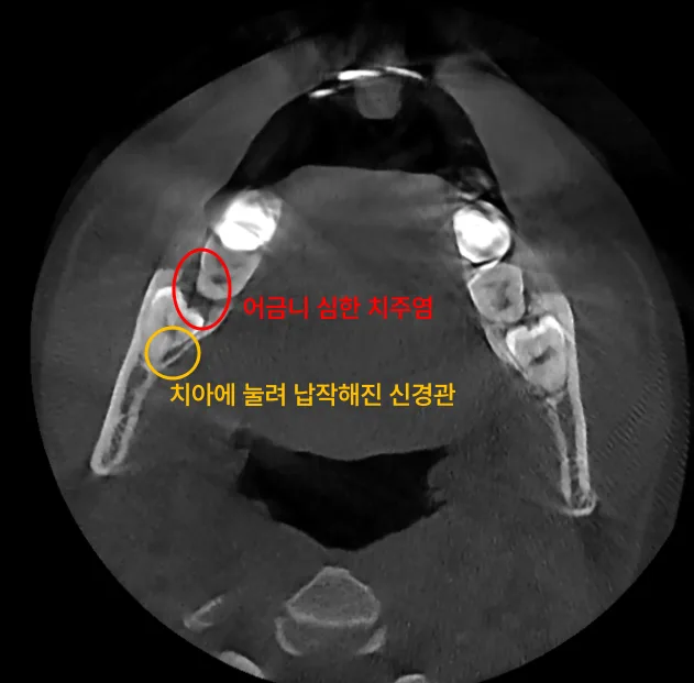 인천구월동치과 발치 후 다시 아픈 이유 5 하악 좌측 어금니 주변의 치주염과 신경관이 눌려 납작해진 모습을 보여주는 치과 CT 사진