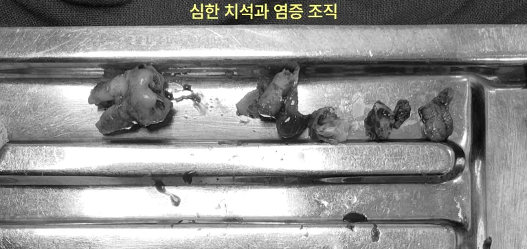 인천구월동치과 발치 후 다시 아픈 이유 6 치과용 트레이 위에 놓인 여러 개의 치석과 염증 조직 조각들