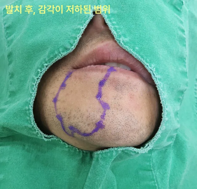 인천구월동치과 발치 후 다시 아픈 이유 7 환자의 턱과 입술 부위에 감각이 저하된 범위를 보라색 펜으로 표시한 모습