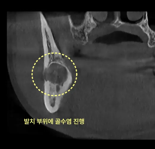 인천구월동치과 발치 후 다시 아픈 이유 9 하악 좌측 발치 부위에 골수염이 진행 중인 것을 보여주는 치과 CT 사진