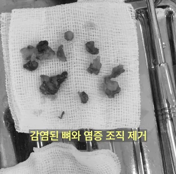 인천구월동치과 발치 후 다시 아픈 이유 10 거즈 위에 놓인 감염된 뼈와 염증 조직 조각들