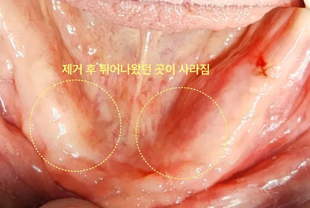 하악골융기 제거 후 평평해진 구강 내부 모습