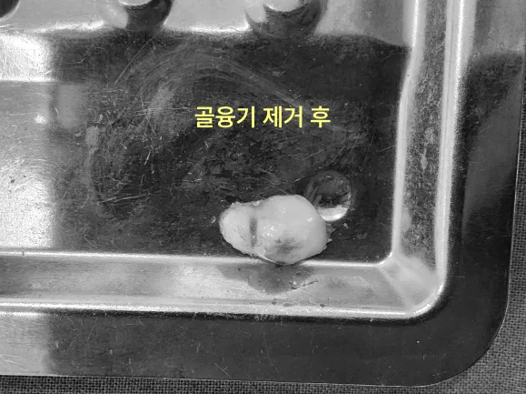 수술용 트레이 위에 놓인 하악골융기 제거 조직 흑백 사진