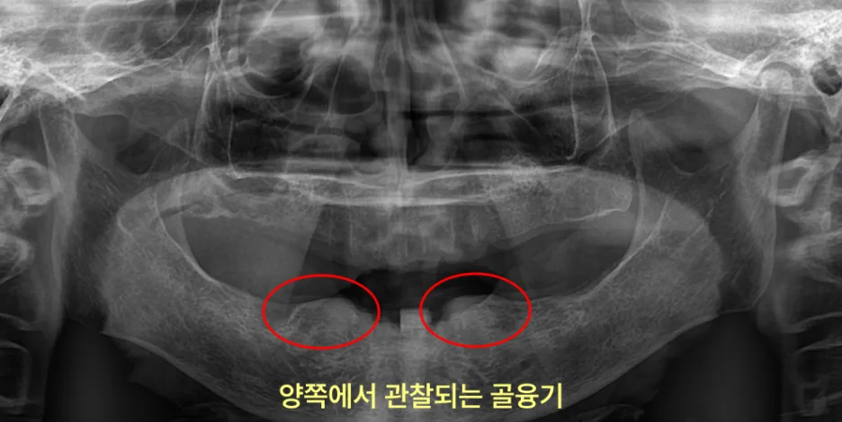 가정동치과 하악골융기, 혀 밑 뼈 제거 기준 4 환자의 파노라마 방사선 사진에서 혀 밑 골융기가 빨간색 원으로 표시된 모습