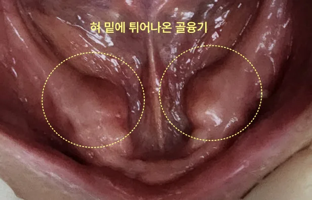 가정동치과 하악골융기, 혀 밑 뼈 제거 기준 5 환자의 구강 내 혀 밑에 튀어나온 골융기가 노란색 점선 원으로 표시된 모습