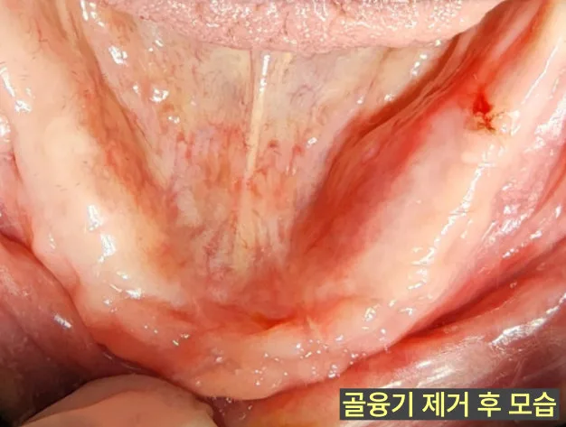 가정동치과 하악골융기, 혀 밑 뼈 제거 기준 6 혀 밑 골융기 제거 수술 후 환자의 구강 내부 모습